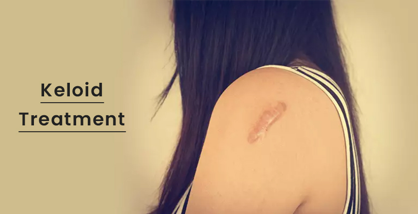 Keloid Treatment in Ahmedabad